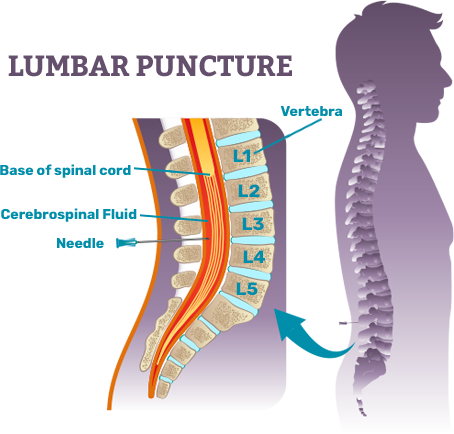 Lumbar Puncture